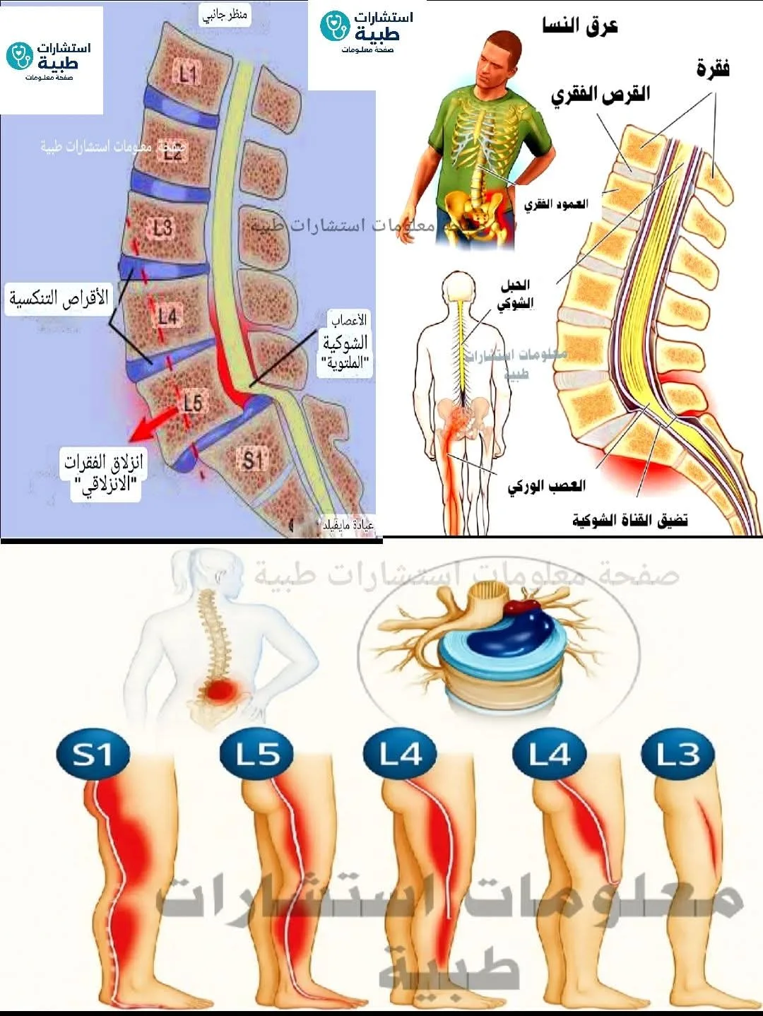 علاج السياتيكا بالكليوبراكتيك